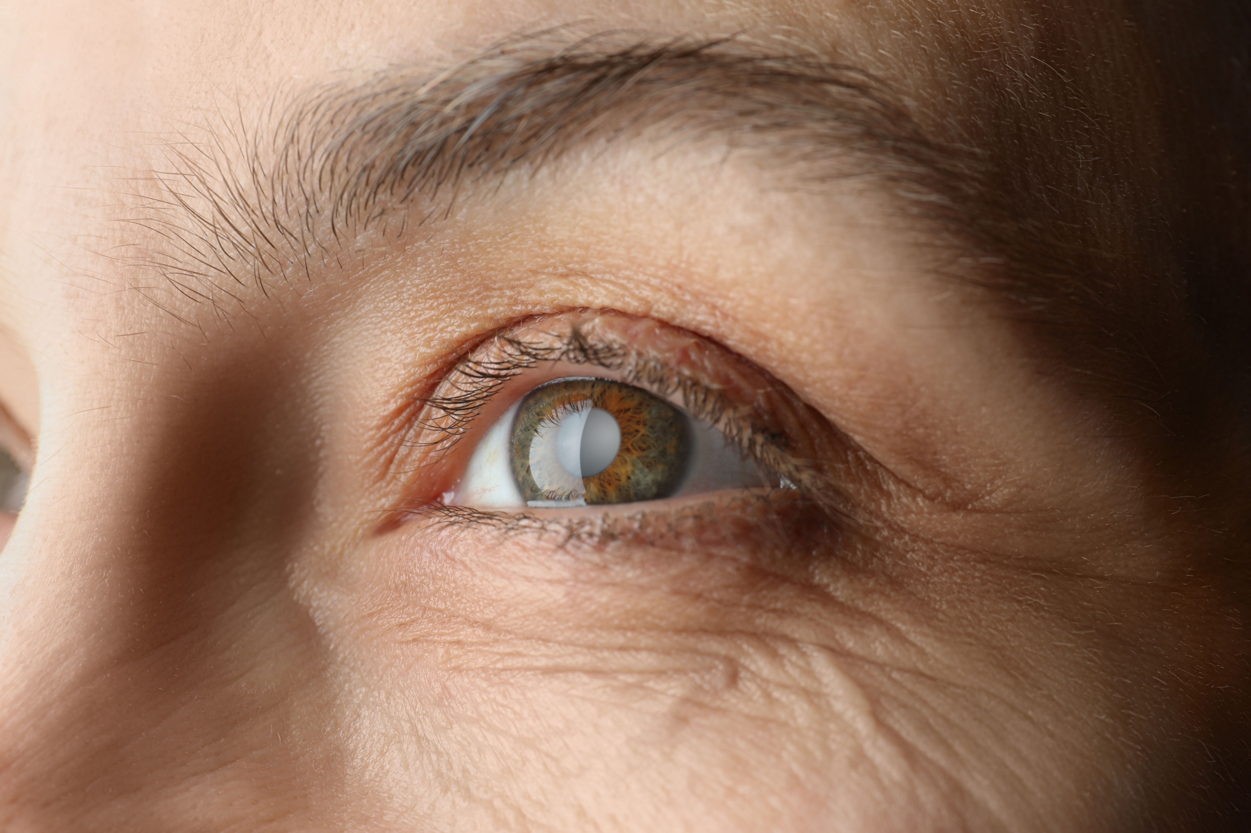 Types of Cataracts and Symptoms to Look For