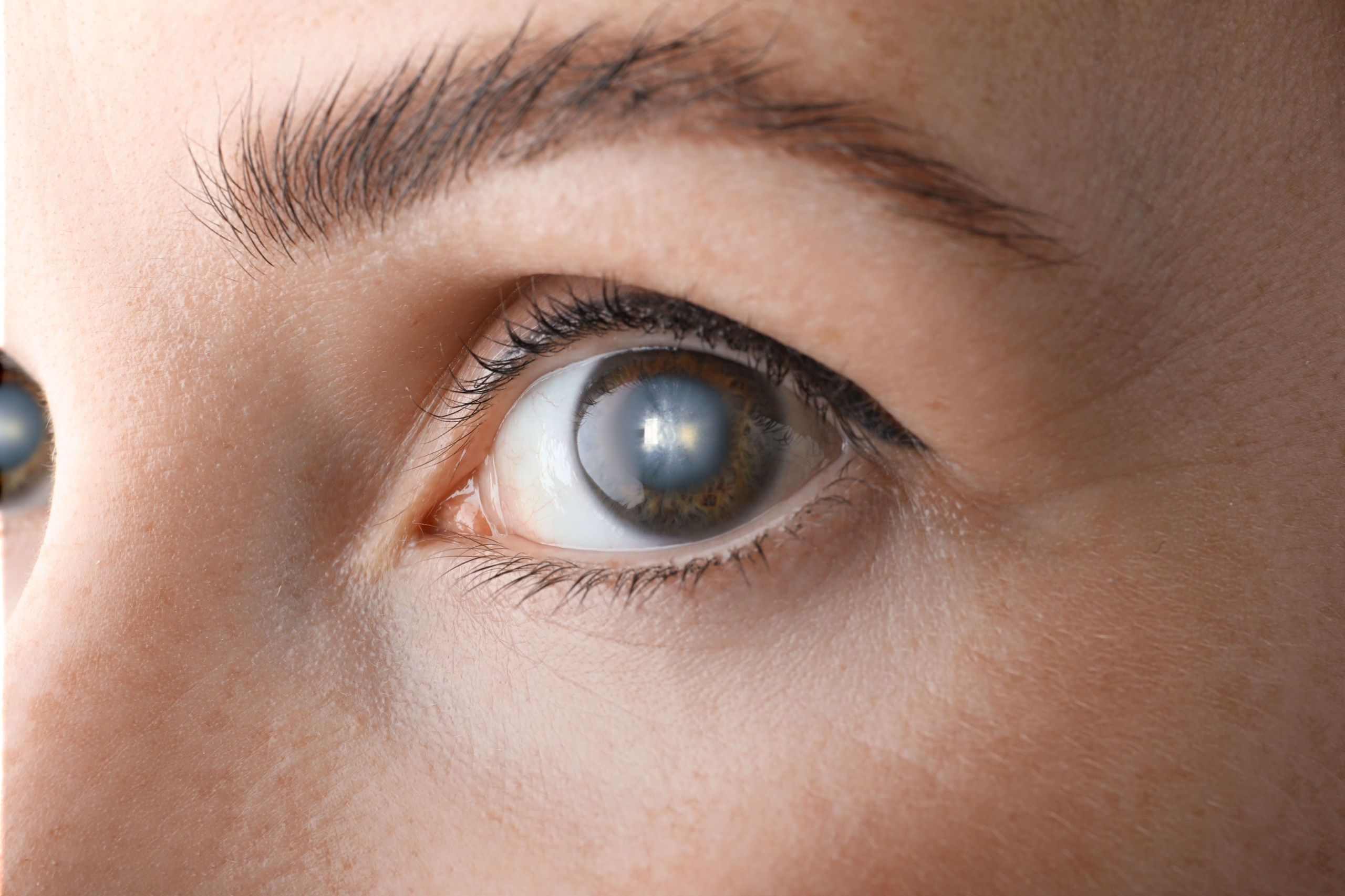 Can Cataracts Return After Surgery?